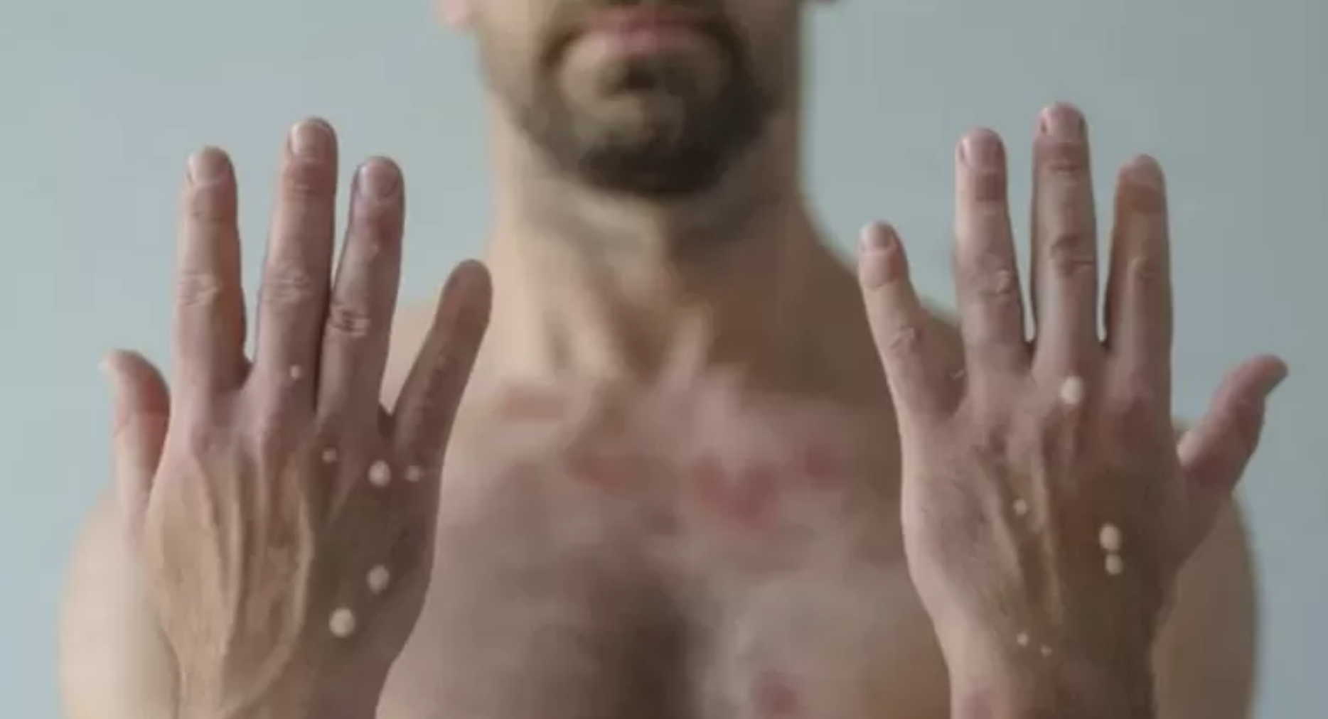 Viruela símica