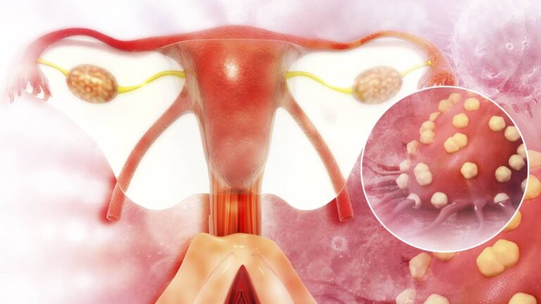 Alrededor de 3.000 mexicanas mueren anualmente por cáncer de ovario