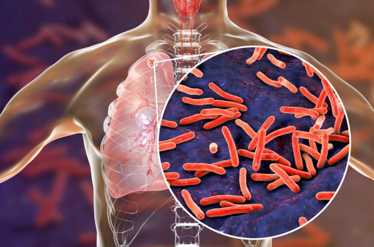 Guerras y pandemia contribuyeron a un aumento de las muertes por tuberculosis